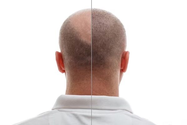 Tête d'un homme chauve avant et après une greffe de cheveux