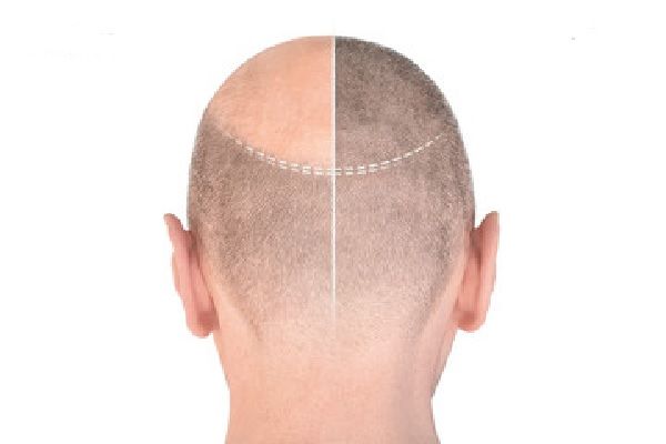 Tête d'un homme chauve avant et après une greffe de cheveux. Combien coûte une greffe de cheveux en France