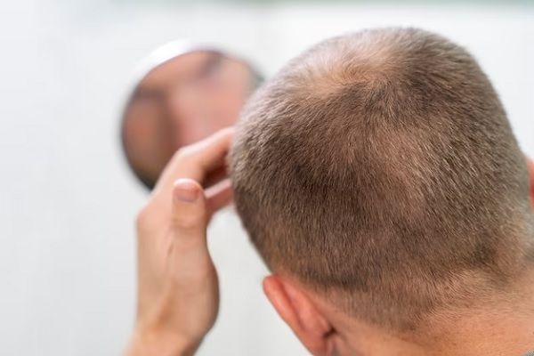 Homme adulte ayant des problèmes de calvitie. Shampoing pour alopécie androgénétique