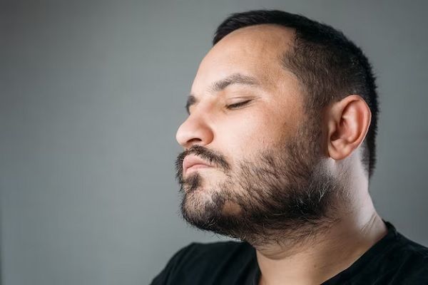 homme avec une zone d'alopécie dans la barbe, l'alopécie