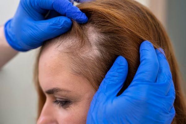 femme recevant un traitement contre la perte de cheveux dans une clinique