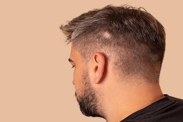 homme atteint d'alopécie photo en gros plan. 