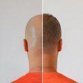Quels sont les effets secondaires d'une greffe de cheveux