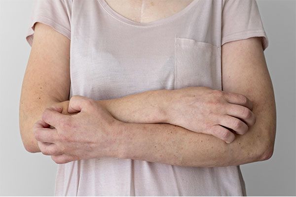 Une femme souffre d'éruptions cutanées sur les bras.