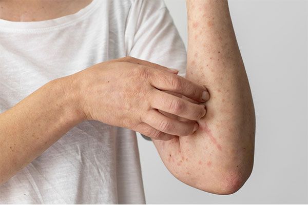 L'homme souffre d'un psoriasis sec ou squameux sur le coude du bras. Les différences entre l'eczéma et le psoriasis 