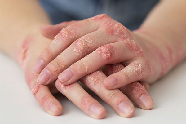 L'eczéma apparaît très souvent sur les mains. Les différences entre l'eczéma et le psoriasis
