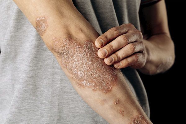 L'homme souffre d'un psoriasis sec ou squameux sur le coude du bras.