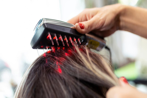 le cuir chevelu d'une femme reçoit un traitement au laser par brossage 