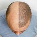 La perte de cheveux est un problème courant qui peut avoir un impact significatif sur l’estime de soi et la confiance en soi. Heureusement, à Paris, il existe plusieurs cliniques spécialisées dans les greffes de cheveux, offrant des solutions efficaces et durables pour restaurer la densité capillaire. Dans cet article, nous allons présenter les trois meilleures cliniques de greffe de cheveux à Paris, réputées pour leur expertise, leur technologie de pointe et leur excellent service client.