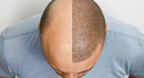 La perte de cheveux est un problème courant qui peut avoir un impact significatif sur l’estime de soi et la confiance en soi. Heureusement, à Paris, il existe plusieurs cliniques spécialisées dans les greffes de cheveux, offrant des solutions efficaces et durables pour restaurer la densité capillaire. Dans cet article, nous allons présenter les trois meilleures cliniques de greffe de cheveux à Paris, réputées pour leur expertise, leur technologie de pointe et leur excellent service client.