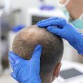 Aujourd'hui, grâce aux progrès de la médecine, la perte de cheveux fait partie du passé pour de nombreuses personnes. L'un des traitements les plus utilisés par les patients atteints d'alopécie areata est l'inhibiteur de Jak. 