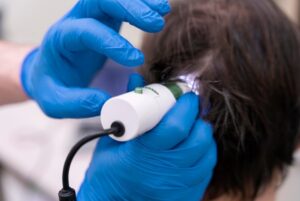 Homme recevant un traitement contre la perte de cheveux