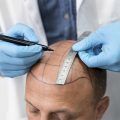 La technique de prothèse capillaire FAS est un produit composé d'un treillis, d'une base et de cheveux naturels ou synthétiques.