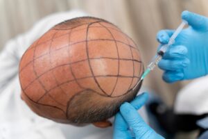 Homme audacieux subissant un processus d'extraction d'unités folliculaires