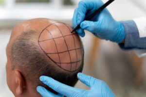 Homme mûr subissant un processus d'extraction d'unités folliculaires
