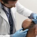 Le développement de cette intervention nécessite une évaluation préalable du patient, qui doit être en bonne santé. Cependant, des facteurs tels qu'un mauvais choix de centre capillaire, un chirurgien expérimenté ou une greffe de cheveux postopératoire inadéquate augmentent la possibilité de souffrir d'effets secondaires.