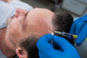 Homme recevant un traitement pour la perte de cheveux