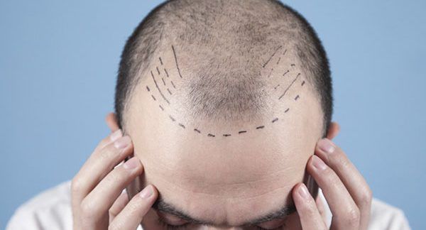 Greffe de cheveux à Paris, comment trouver les meilleures cliniques ? Nombreux sont ceux qui souhaitent avoir une chevelure complète. Cependant, cela n'est pas possible pour tous ceux qui souffrent d'alopécie. Face à une perte de cheveux importante, le volume de la chevelure diminue et l'éclaircissement du cuir chevelu devient plus évident. 