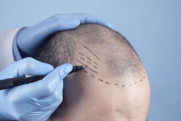 Un homme reçoit le début d'une greffe de cheveux sur son cuir chevelu. 