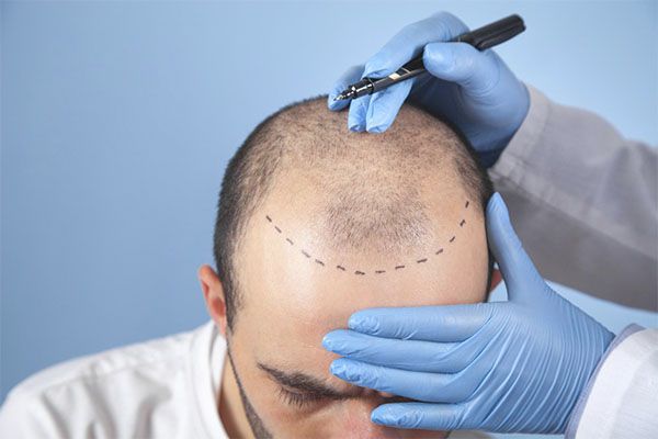homme traité pour une greffe de cheveux , Conseils pour trouver une clinique de greffe de cheveux à Paris