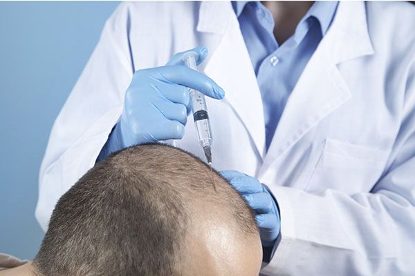 Un homme reçoit une injection dans le cuir chevelu pour procéder à une greffe de cheveux. 