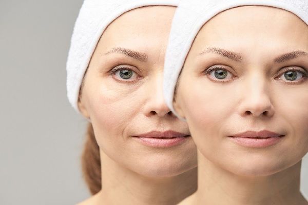 avant et après une femme traitée autour des yeux
