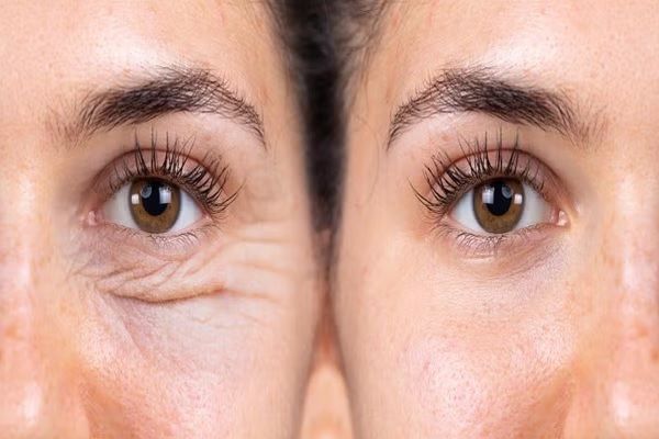 avant et après une femme traitée autour des yeux