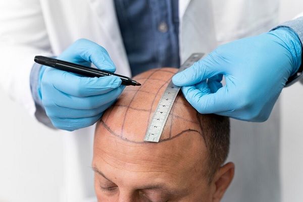 Homme subissant un processus d’extraction d’unités folliculaires Technique MicroFUE qu'est-ce que c'est, avantages et inconvénients 