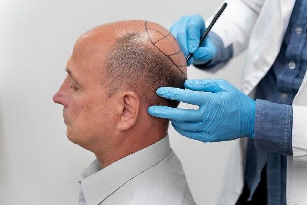 Homme mûr subissant un processus d'extraction d'unité folliculaire. Technique MicroFUE qu'est-ce que c'est, avantages et inconvénients