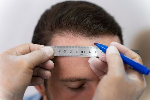 Mâle adulte effectuant une extraction d'unité folliculaire