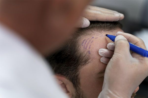 mâle adulte effectuant une extraction d'unité folliculaire.