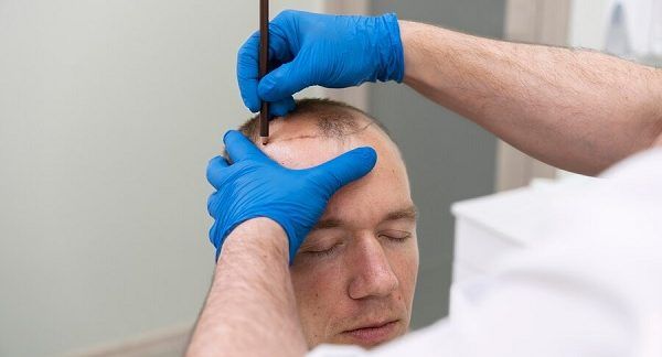 Homme mûr avec problème de calvitie Technique MicroFUE qu'est-ce que c'est, avantages et inconvénients