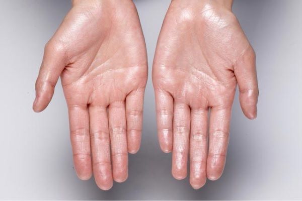 Transpiration excessive - Les mains des femmes visiblement brillantes à cause de l'hyperhidrose
