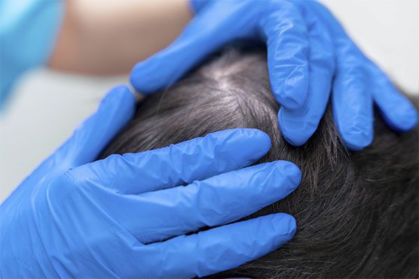 L'inflammation après une greffe de cheveux ne peut pas toujours être évitée.