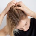 Gros plan sur une femme ayant des pellicules. Le psoriasis capillaire
